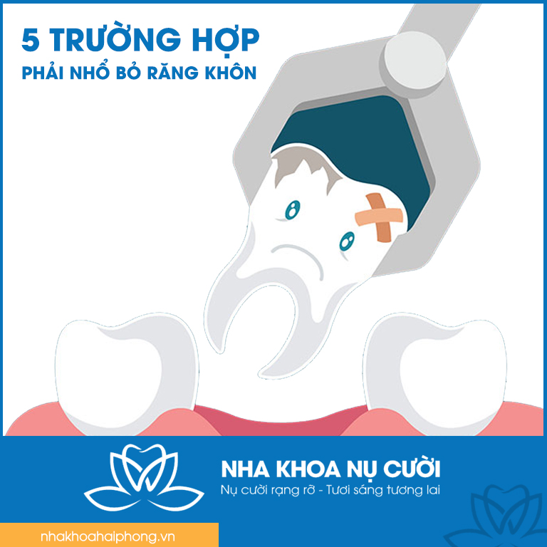 5-truong-hop-can-phai-nho-rang-khon
