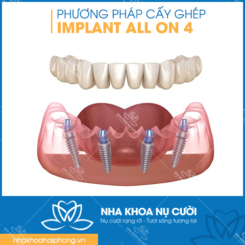 phuong-phap-cay-ghep-implant-on-all-4