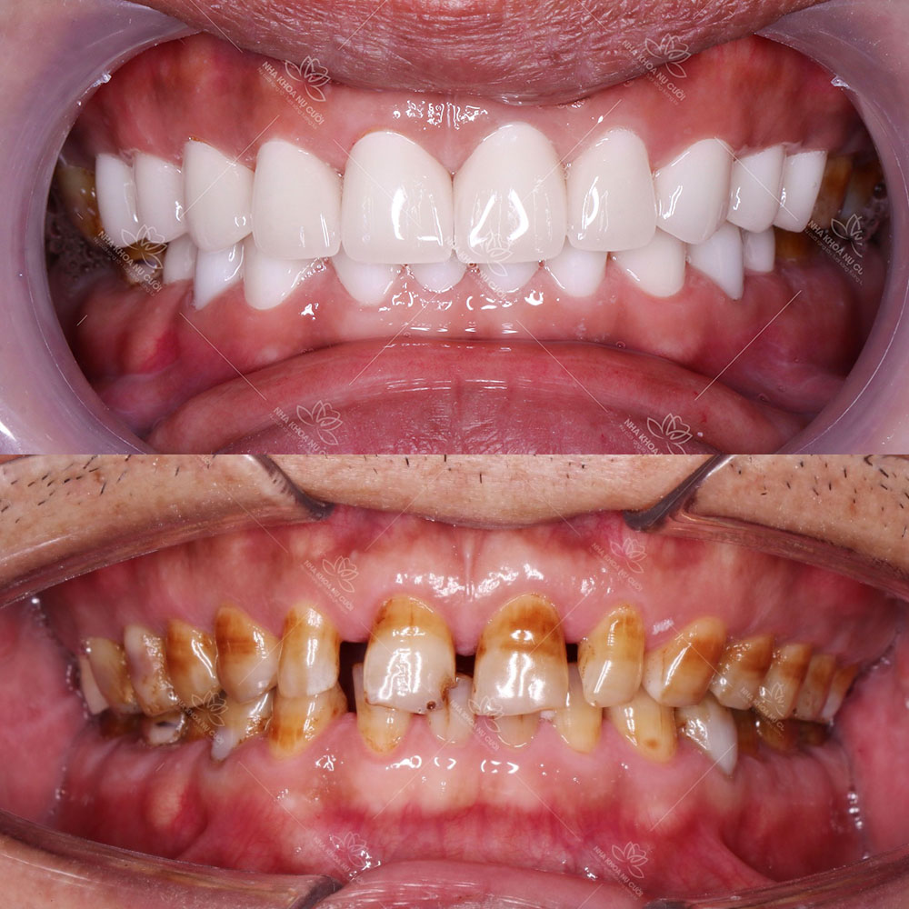 Răng sứ có độ bền & tính thẩm mỹ cao