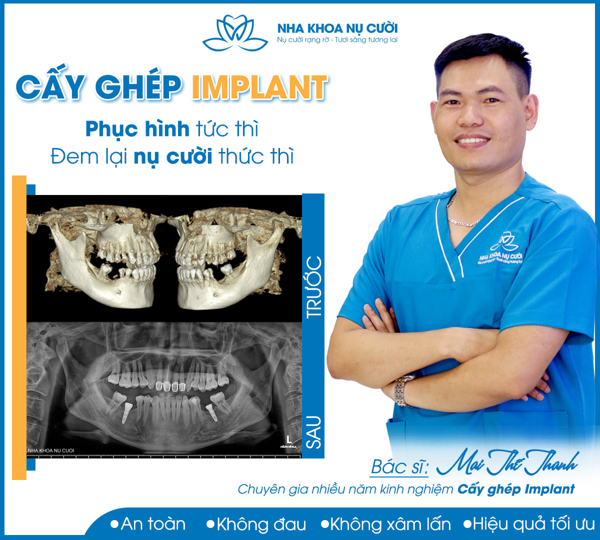 Cấy ghép Implant, giải pháp toàn diện phục hồi răng mất.