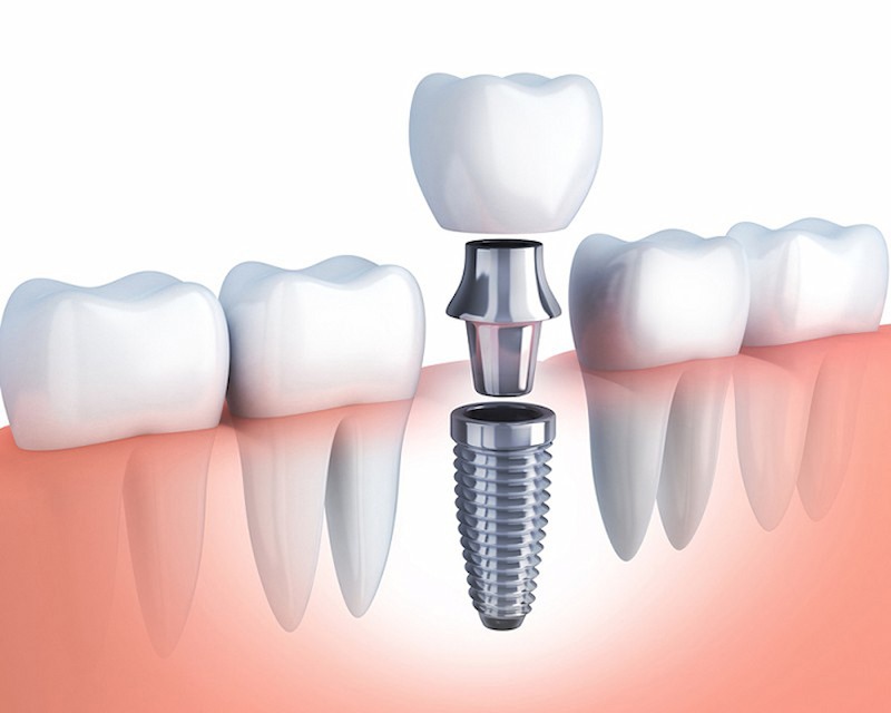 (Ngày càng có nhiều nha khoa mở cửa, quảng cáo dịch vụ trồng răng Implant giá chỉ 2-3 triệu đồng)