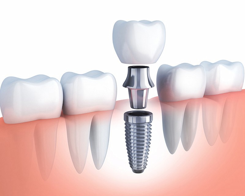 (Độ cứng của trụ quyết định nhiều kết quả điều trị trồng răng implant)