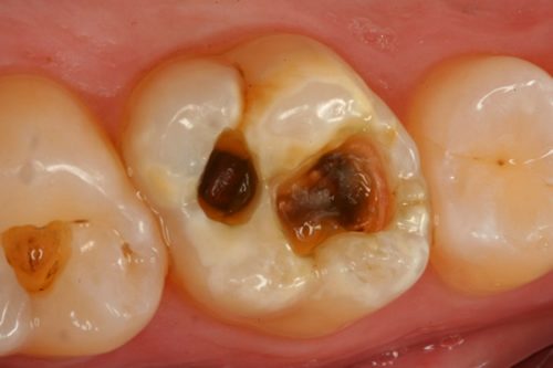 Răng chết tủy là gì? Điều trị răng chết tủy như thế nào?
