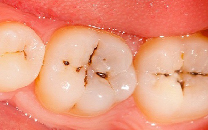 Sâu răng nhẹ đánh răng có hết không – Giải đáp của chuyên gia