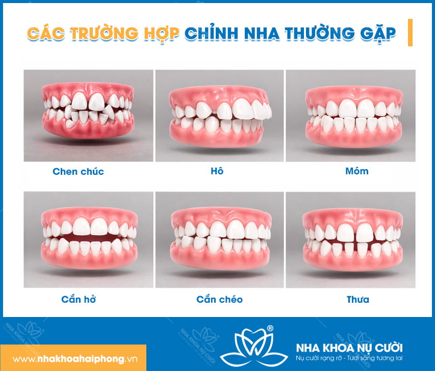 truong-hop-nieng-rang