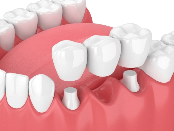 Phương pháp làm cầu răng sứ có bị tiêu xương không?