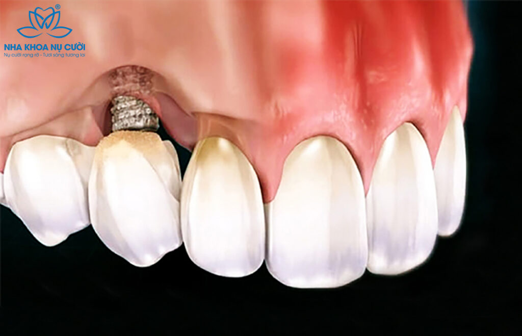(Ngày càng có nhiều nha khoa mở cửa, quảng cáo dịch vụ trồng răng Implant giá chỉ 2-3 triệu đồng)