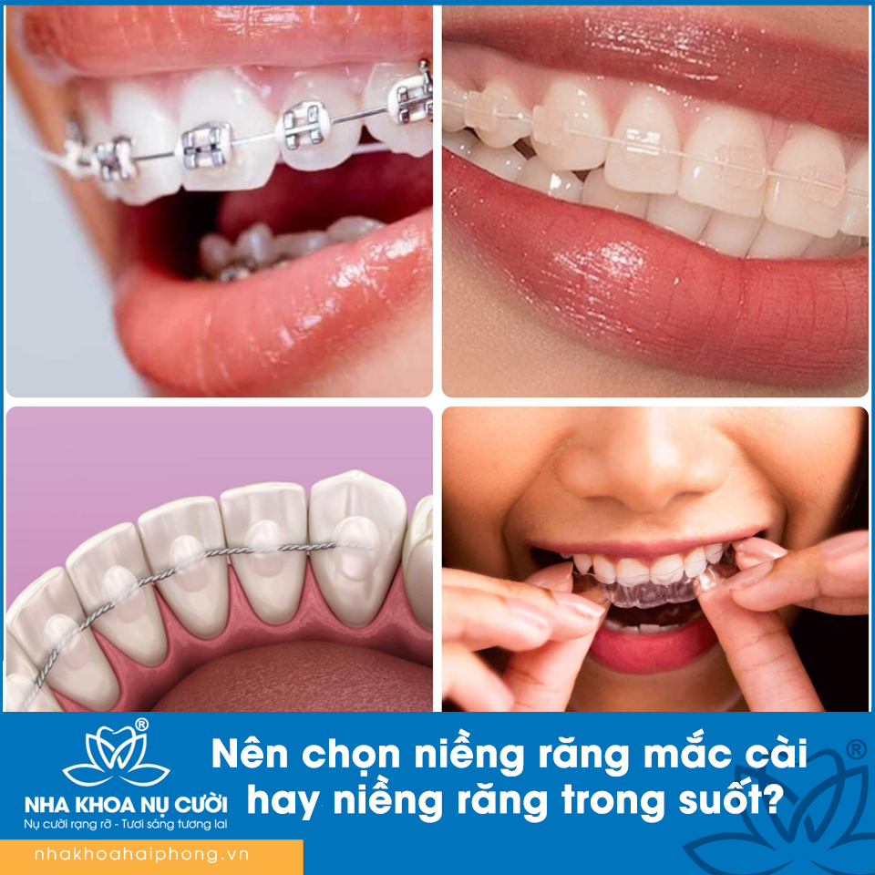 Nên chọn niềng răng mắc cài hay niềng răng trong suốt?