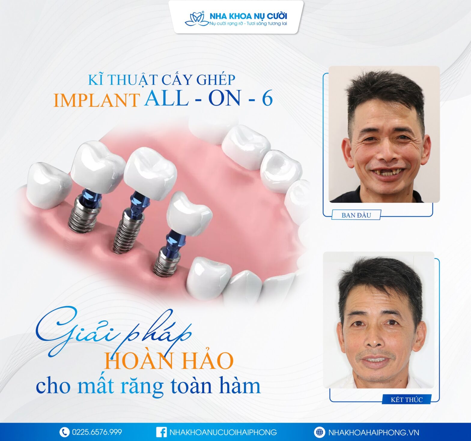 Trồng răng Implant: Phục Sinh Răng Mất – Thoải Mái Ăn Nhai.