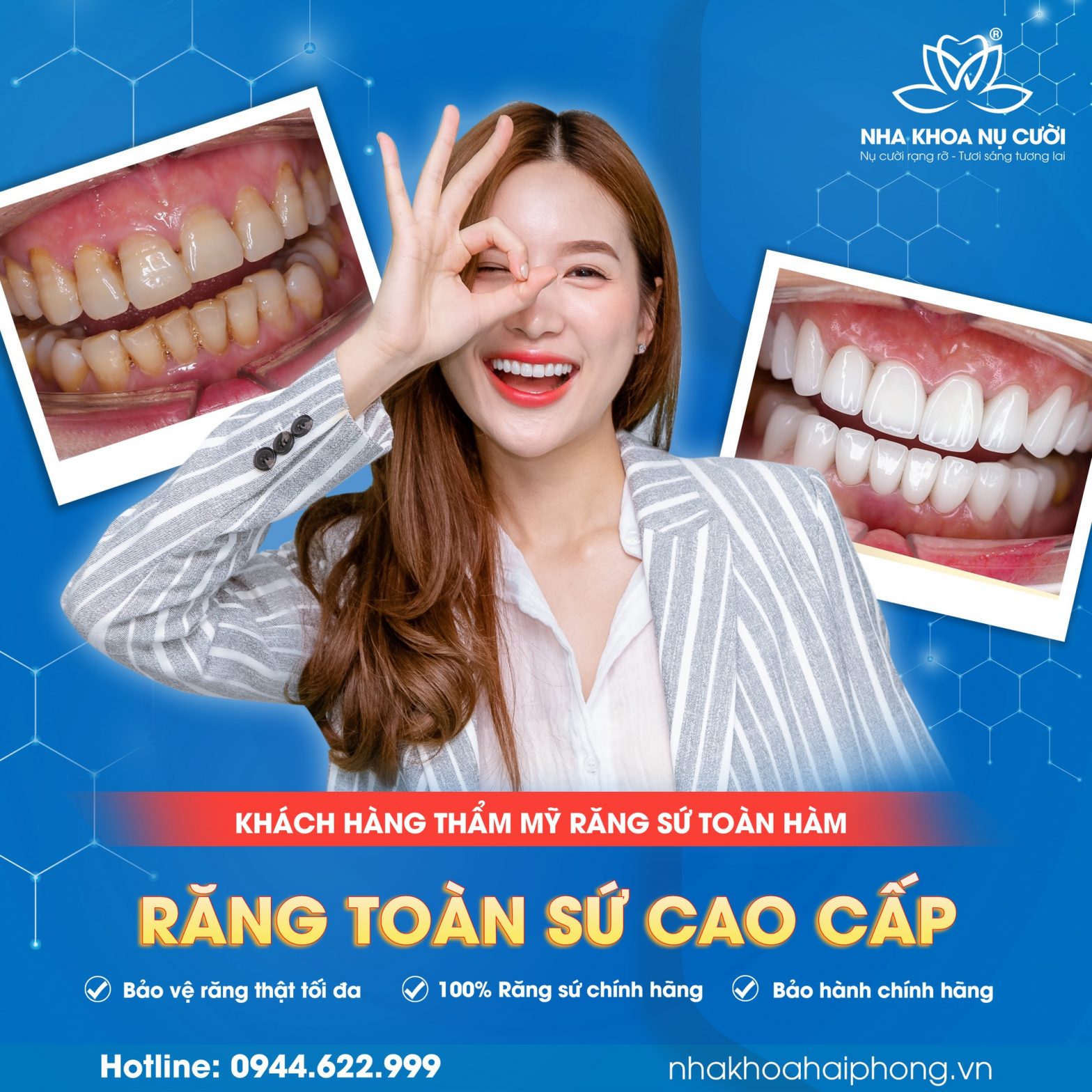 NHỮNG ƯU – NHƯỢC ĐIỂM TỪNG LOẠI RĂNG SỨ CAO CẤP