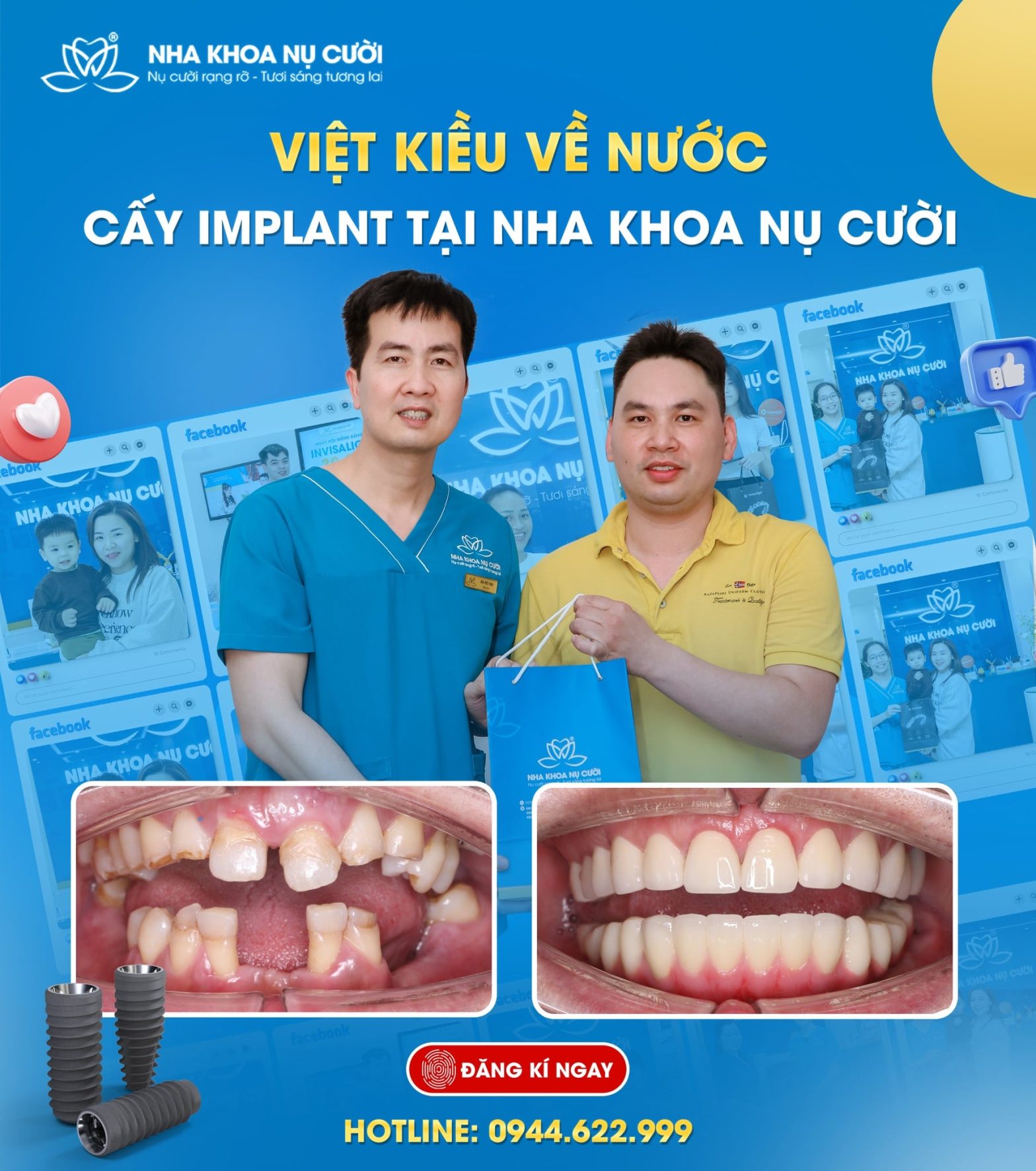 TRỒNG RĂNG IMPLANT TOÀN HÀM CỦA ANH HÀ VĂN QUÝ