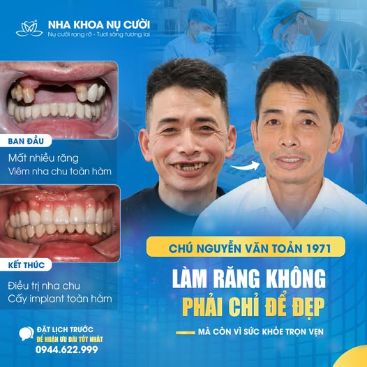trong-rang-implant-uy-tin