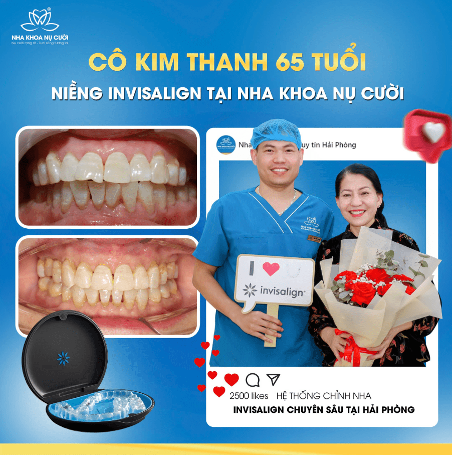 Niềng răng Invisalign của Cô Trần Thị Kim Thanh