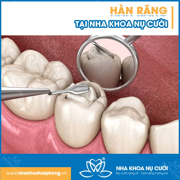 NHỮNG TRƯỜNG HỢP CẦN HÀN RĂNG?