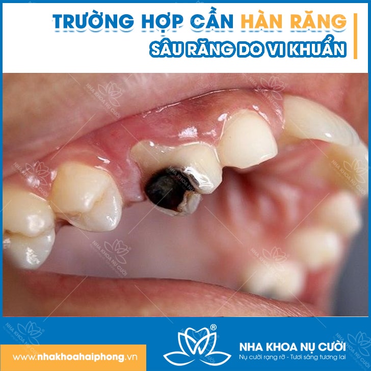 truong-hop-can-han-rang