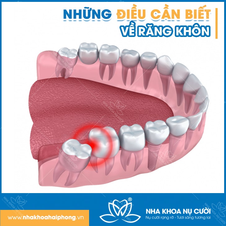 TẤT CẢ NHỮNG ĐIỀU CẦN BIẾT VỀ RĂNG KHÔN