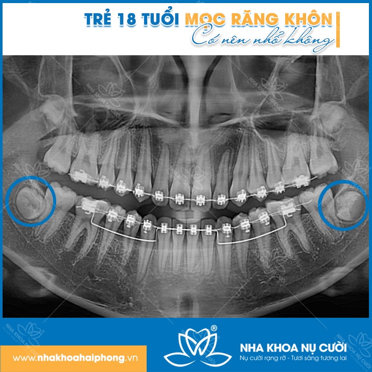 tre-18-tuoi-moc-rang-khon