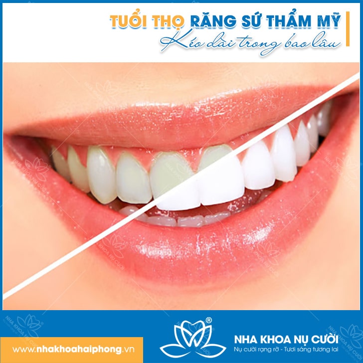 TUỔI THỌ RĂNG SỨ THẨM MỸ KÉO DÀI BAO LÂU