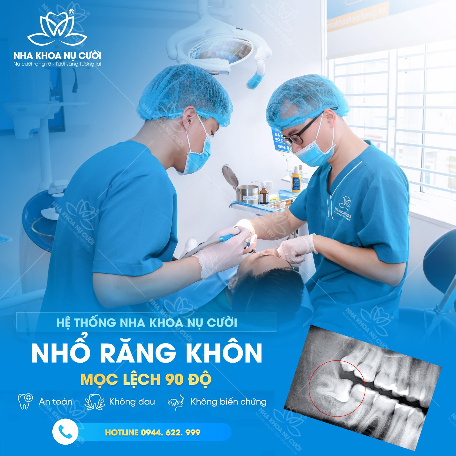 Răng Khôn Mọc Lệch 90 Độ Có Nên Nhổ Không? 