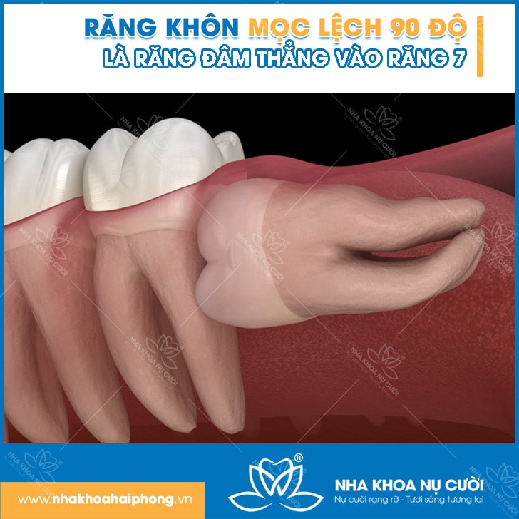 RANG-KHON-MOC-LECH-90
