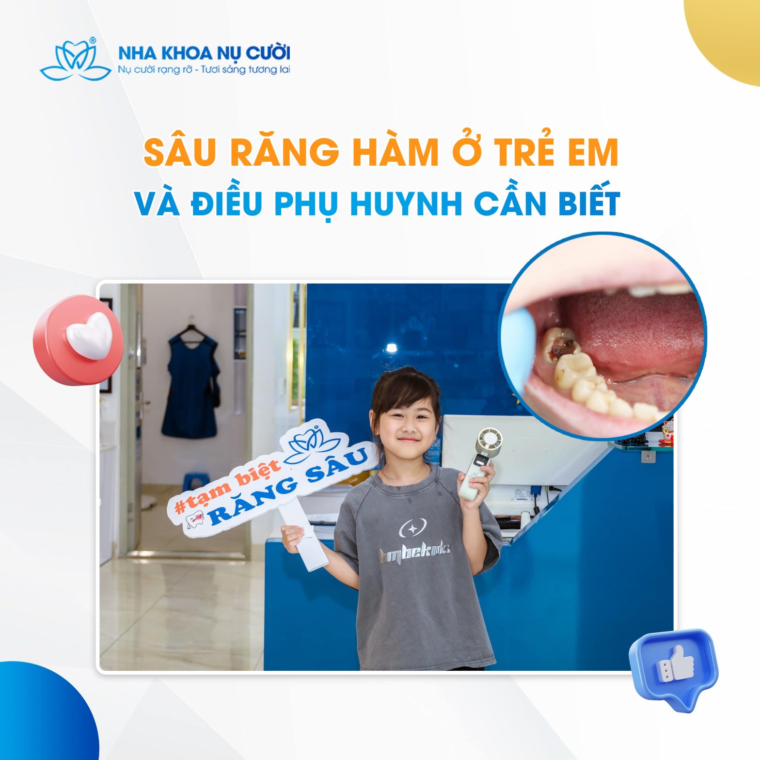 Sâu Răng Hàm Ở Trẻ – Phụ Huynh Cần Biết