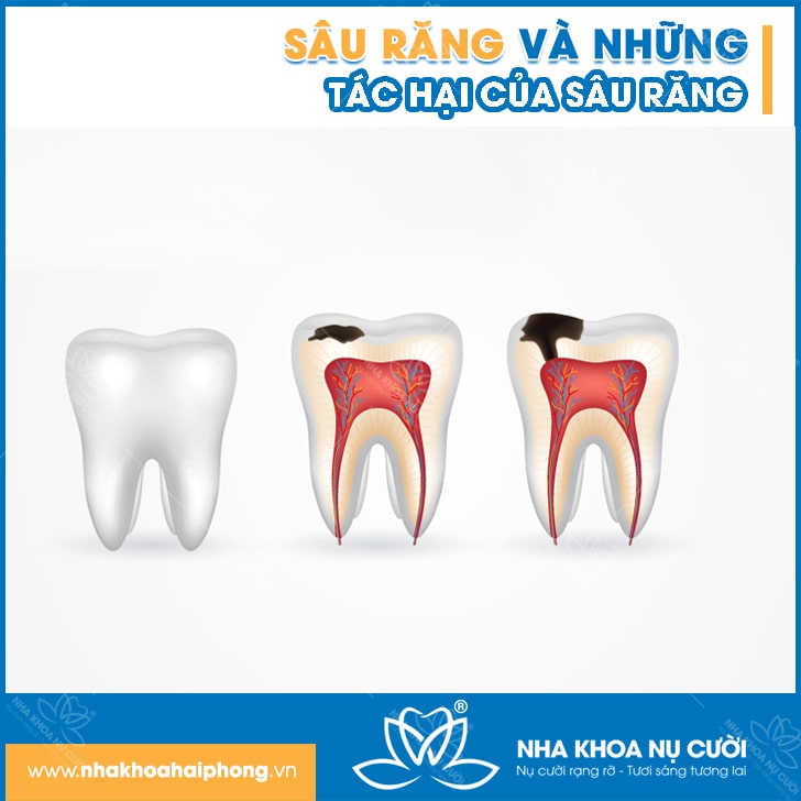 Sâu Răng và Những Tác Hại Của Sâu Răng
