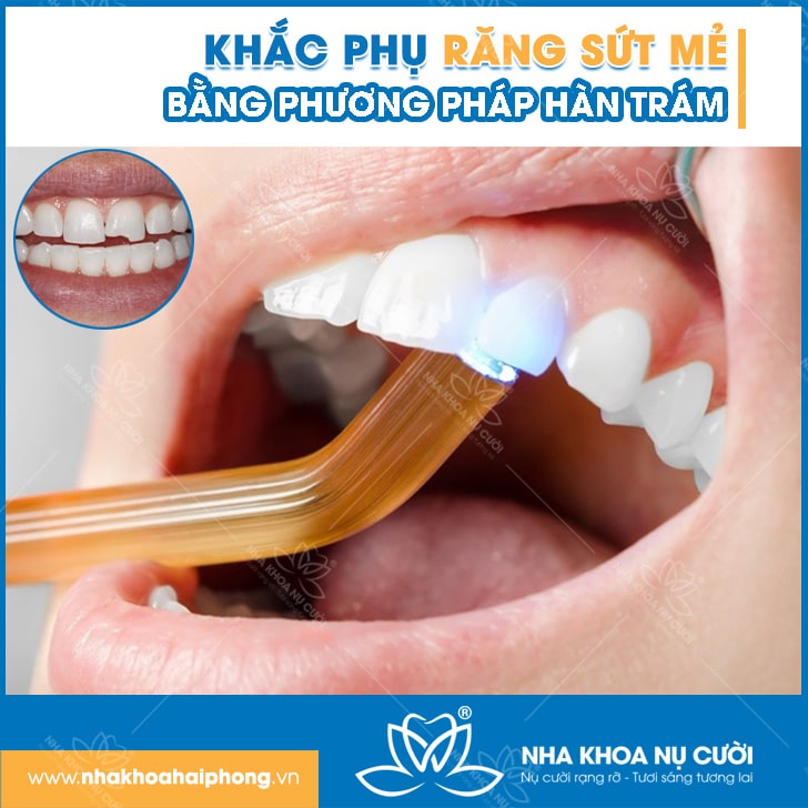 Khắc Phục Răng Sứt Mẻ Bằng Phương Pháp Hàn