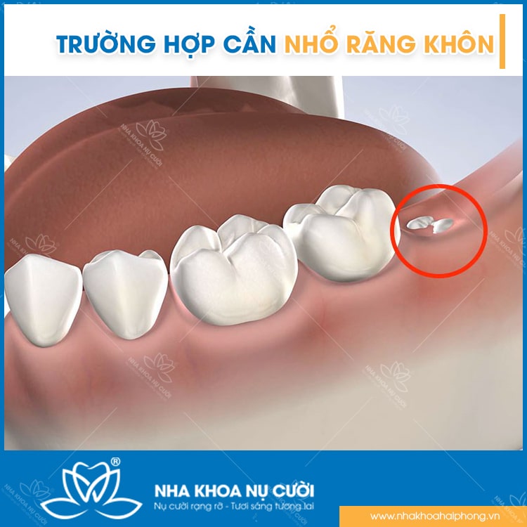 Những Trường Hợp Nào Cần Phải Nhổ Răng Khôn?