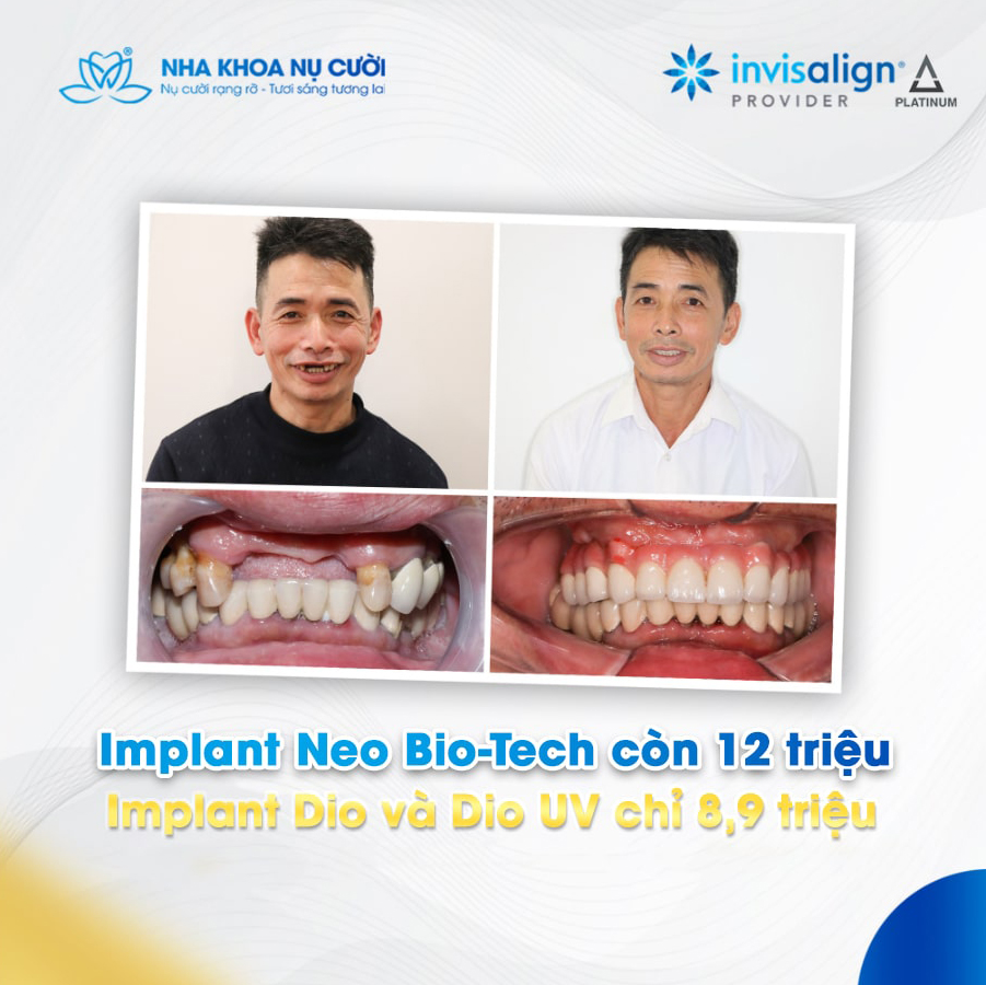 implant