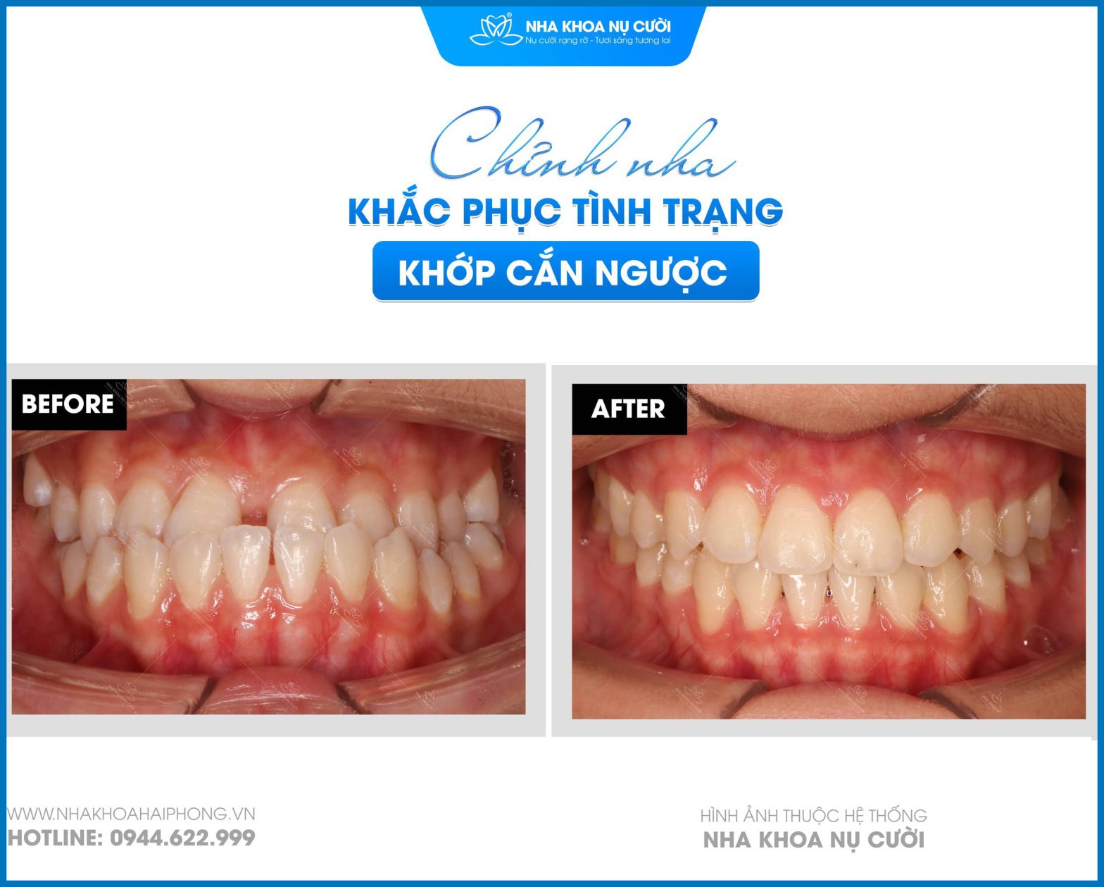 Động lực niềng răng từ câu chuyện đổi thay khớp cắn ngược