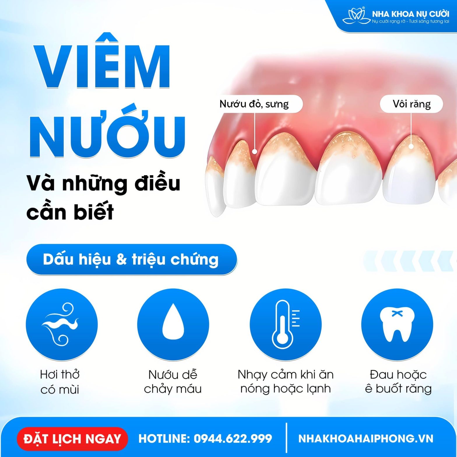 Viêm nướu và những điều bạn cần phải biết
