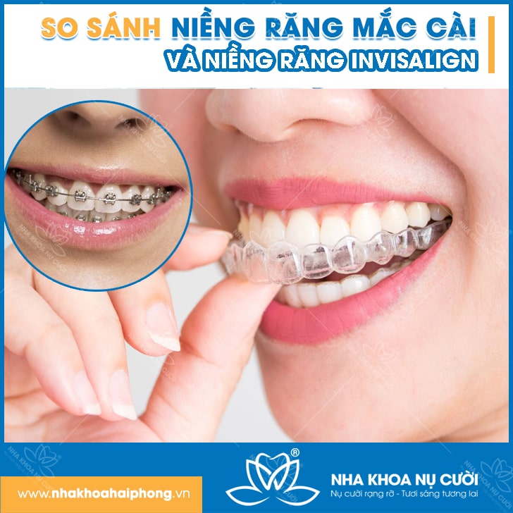 So sánh niềng răng mắc cài và niềng răng Invisalign