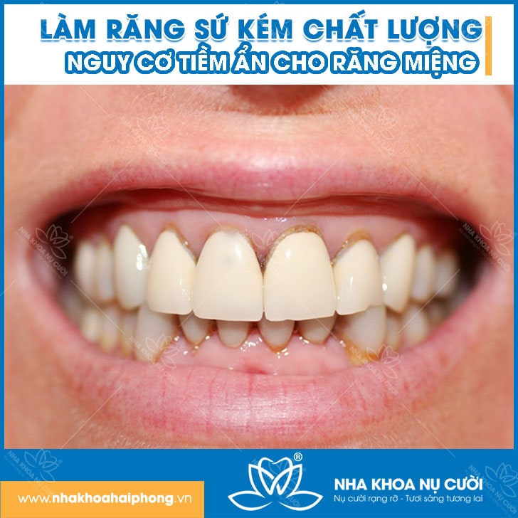 rang-su-kem-chat-luong
