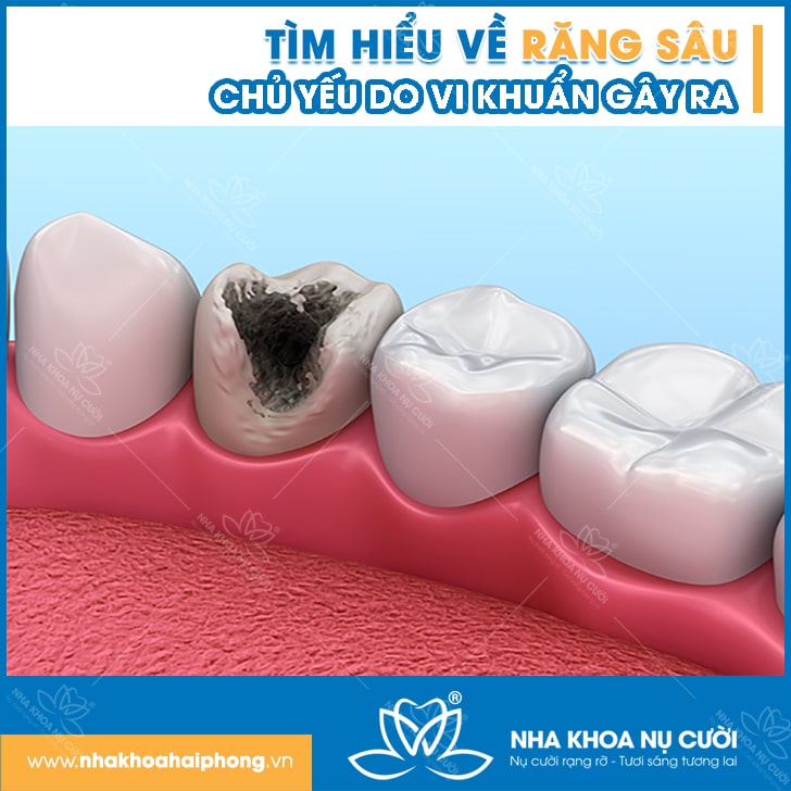 sau-rang-va-cach-khac-phuc