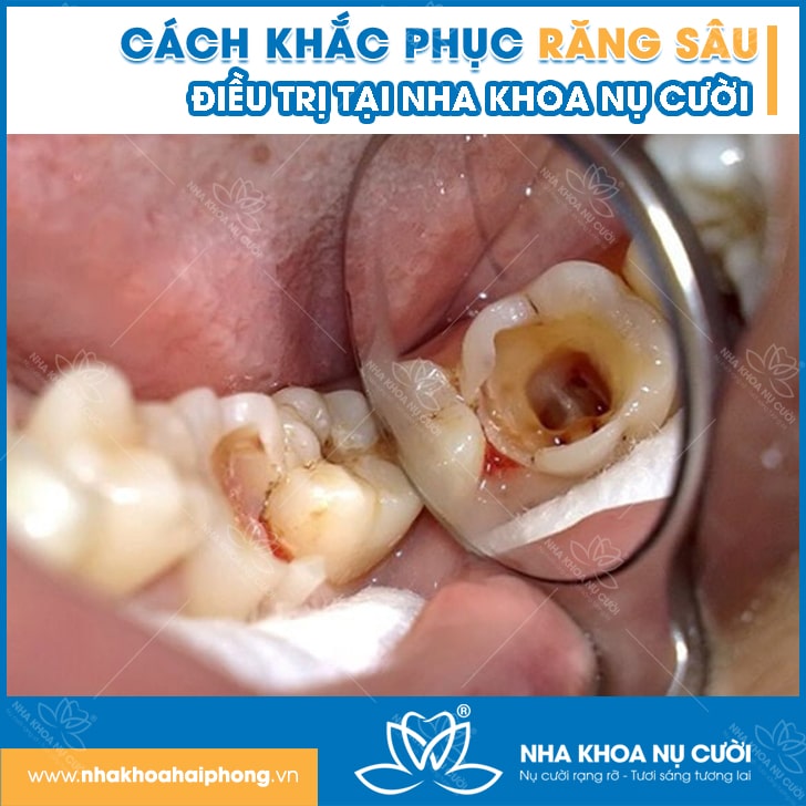 sau-rang-va-cach-khac-phuc