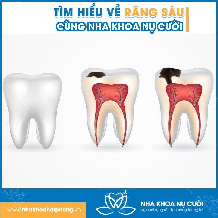 Tìm Hiểu Sâu Răng Và Cách Khắc Phục Hiệu Quả