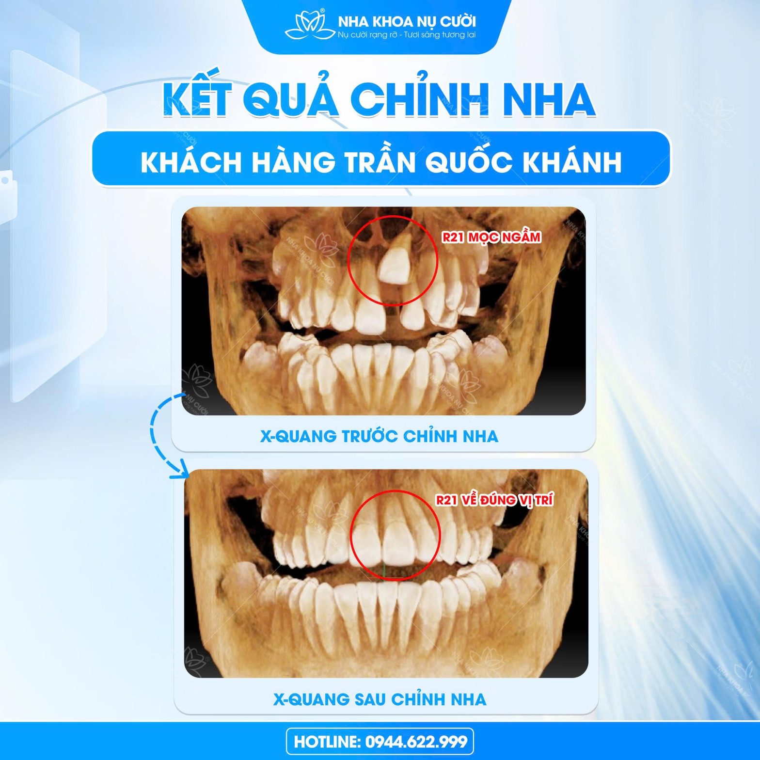 Phát Hiện Sớm Răng Cửa Mọc Ngầm Ở Trẻ Tránh Biến Chứng