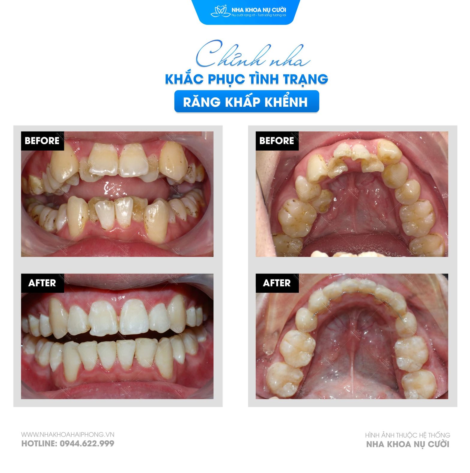 Răng Khấp Khểnh, Lệch Lạc – Có Nên Niềng Không?