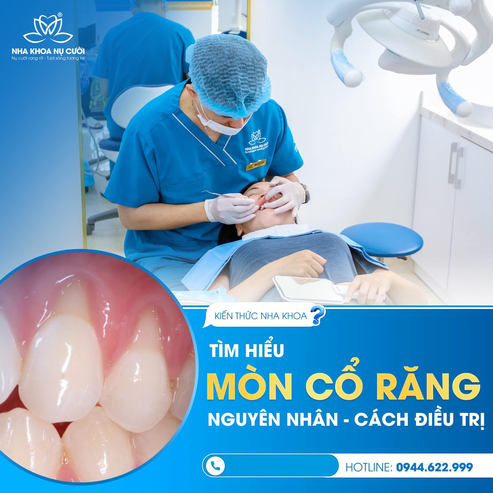 Mòn cổ răng – Nguyên nhân và giải pháp điều trị