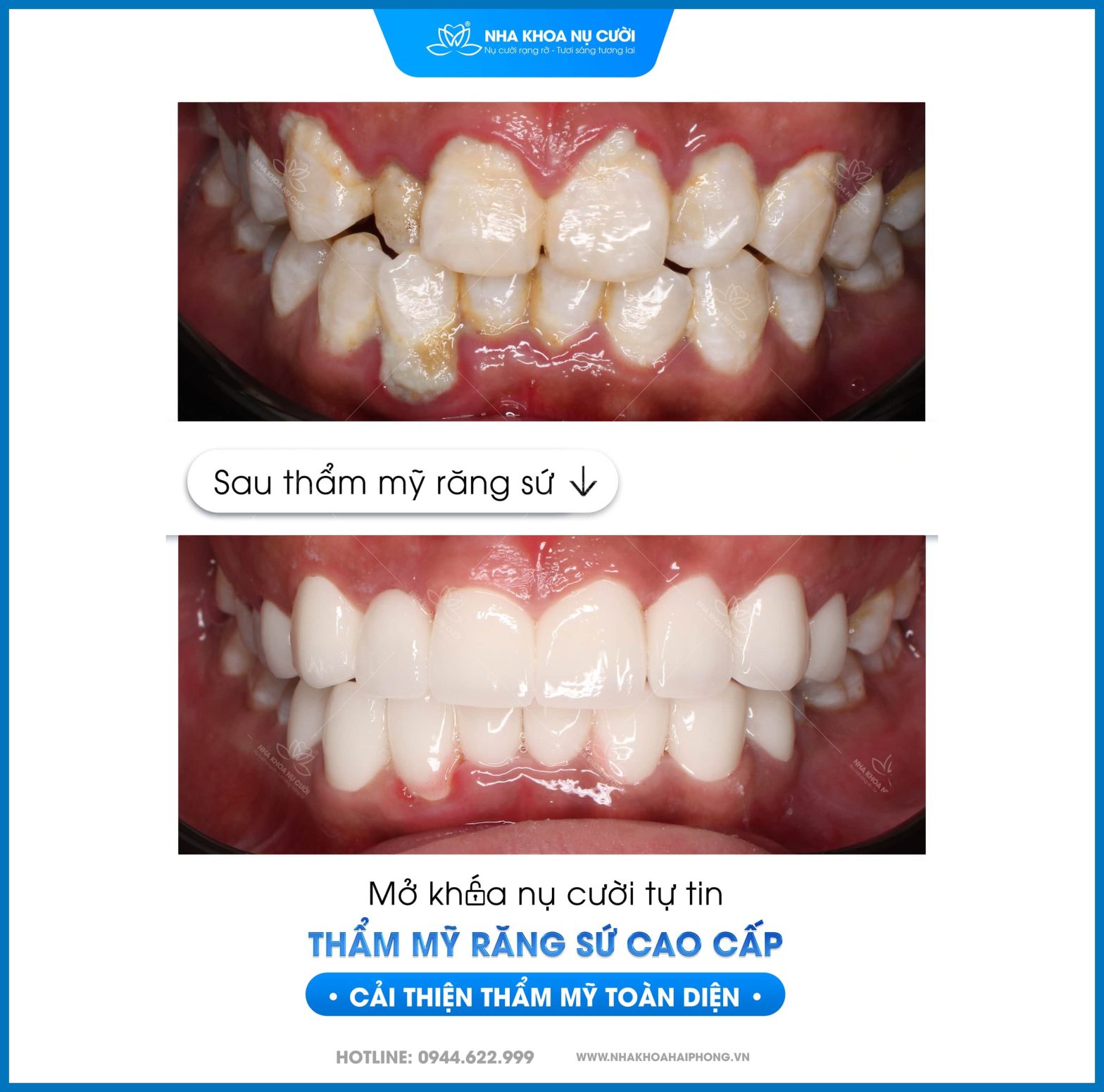 Bí Quyết Có Nụ Cười Đẹp Đón Tết Bính Ngọ