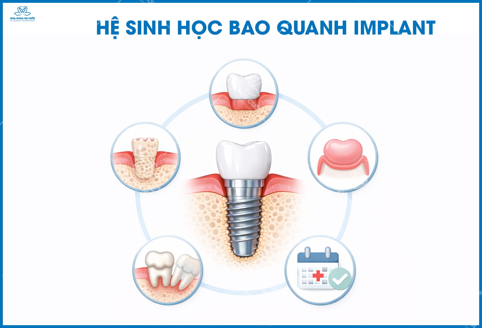 Implant có bền suốt đời không? Khi nào cần thay lại?
