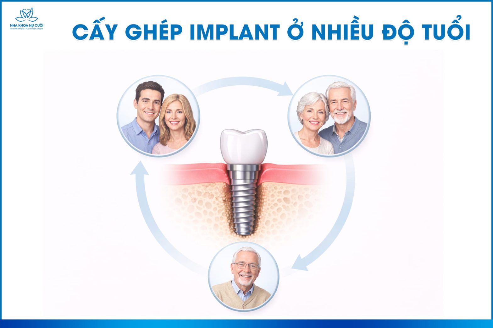 Mất răng lâu năm có trồng Implant được không hay phải ghép xương?