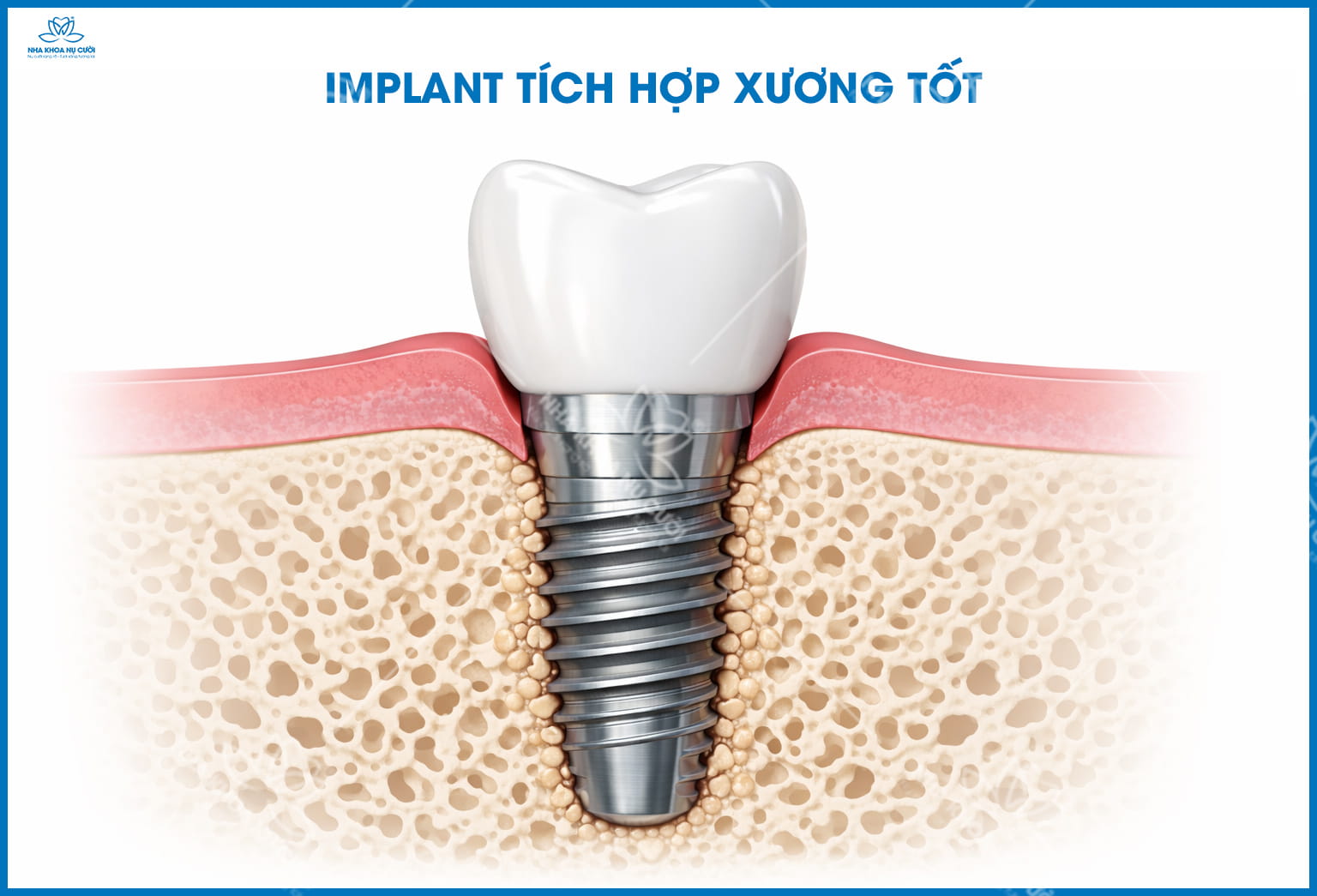 Implant có bền suốt đời không? Khi nào cần thay lại?