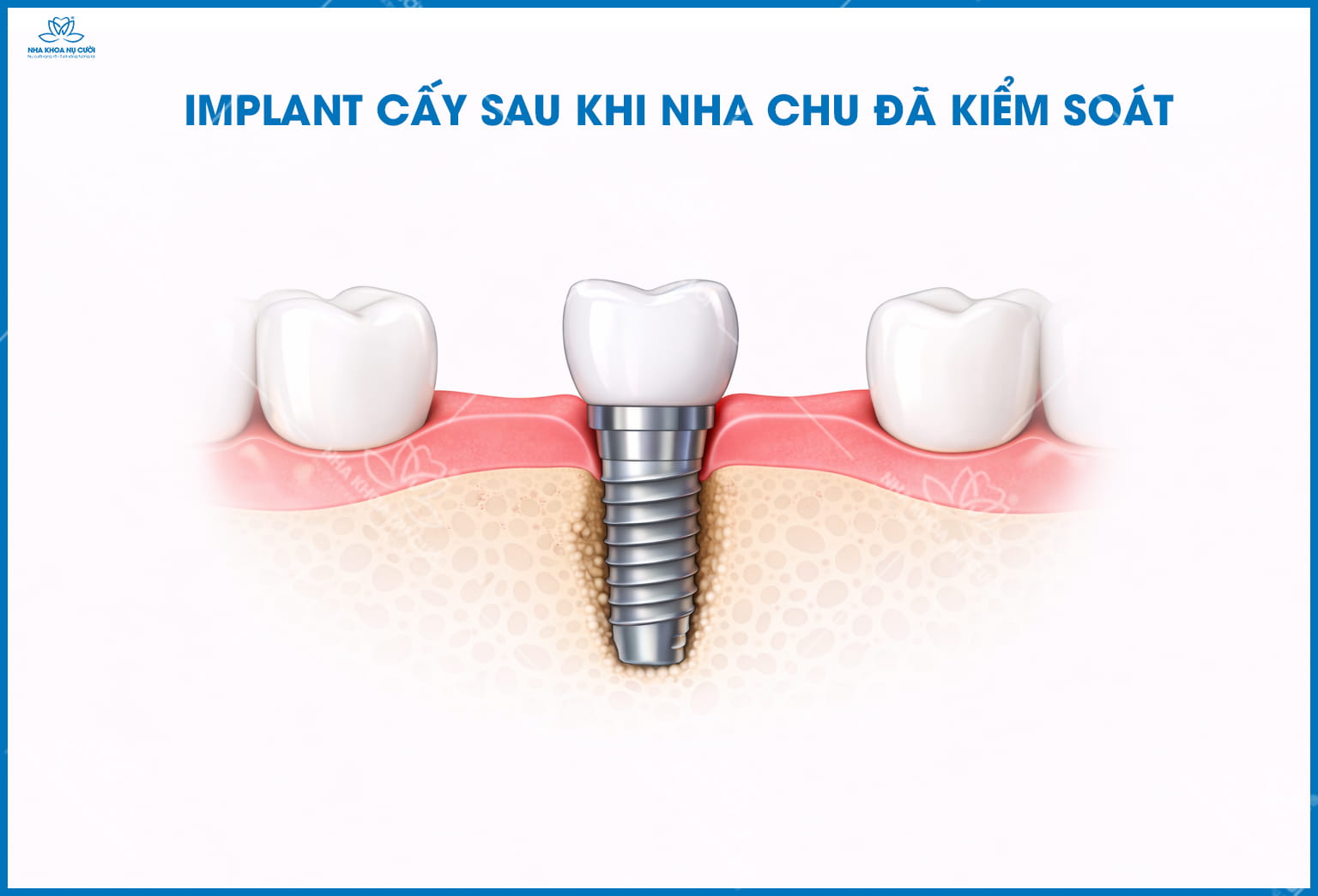 Bị viêm nha chu có trồng Implant được không? Khi nào là an toàn?