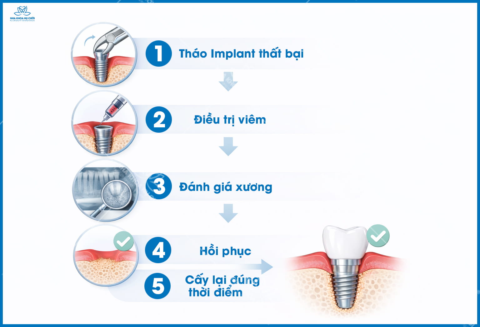 Implant thất bại có làm lại được không? Cần biết rõ trước khi quyết định
