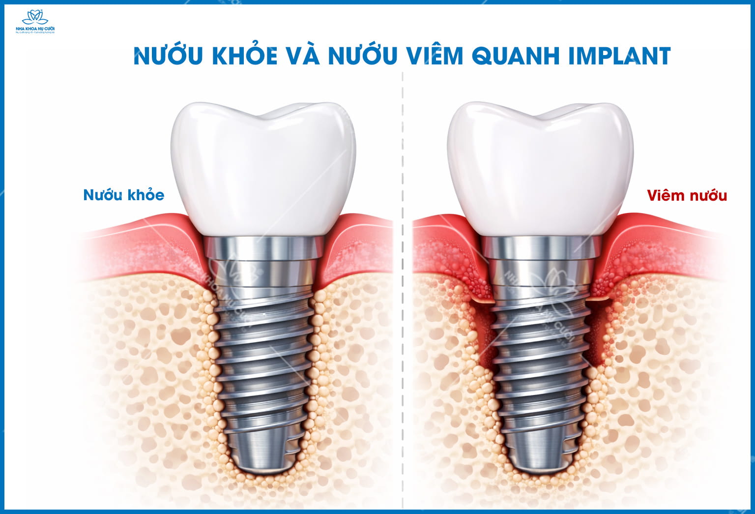 Vì sao Implant bị đào thải? Dấu hiệu sớm không nên bỏ qua