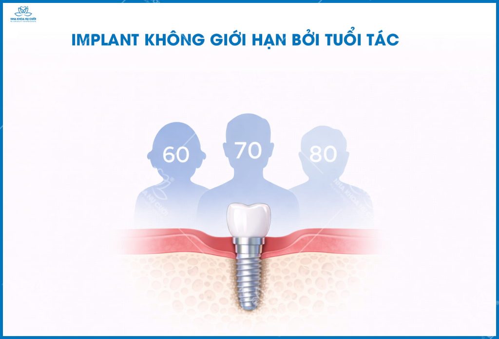 implant