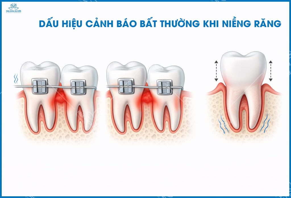 dau-hieu-canh-bao-rang-bat-thuong-khi-chinh-nha