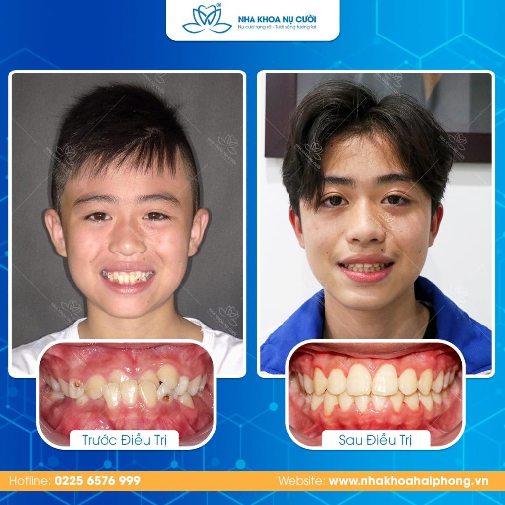 NIENG-RANG-SOM-CHO-TRE