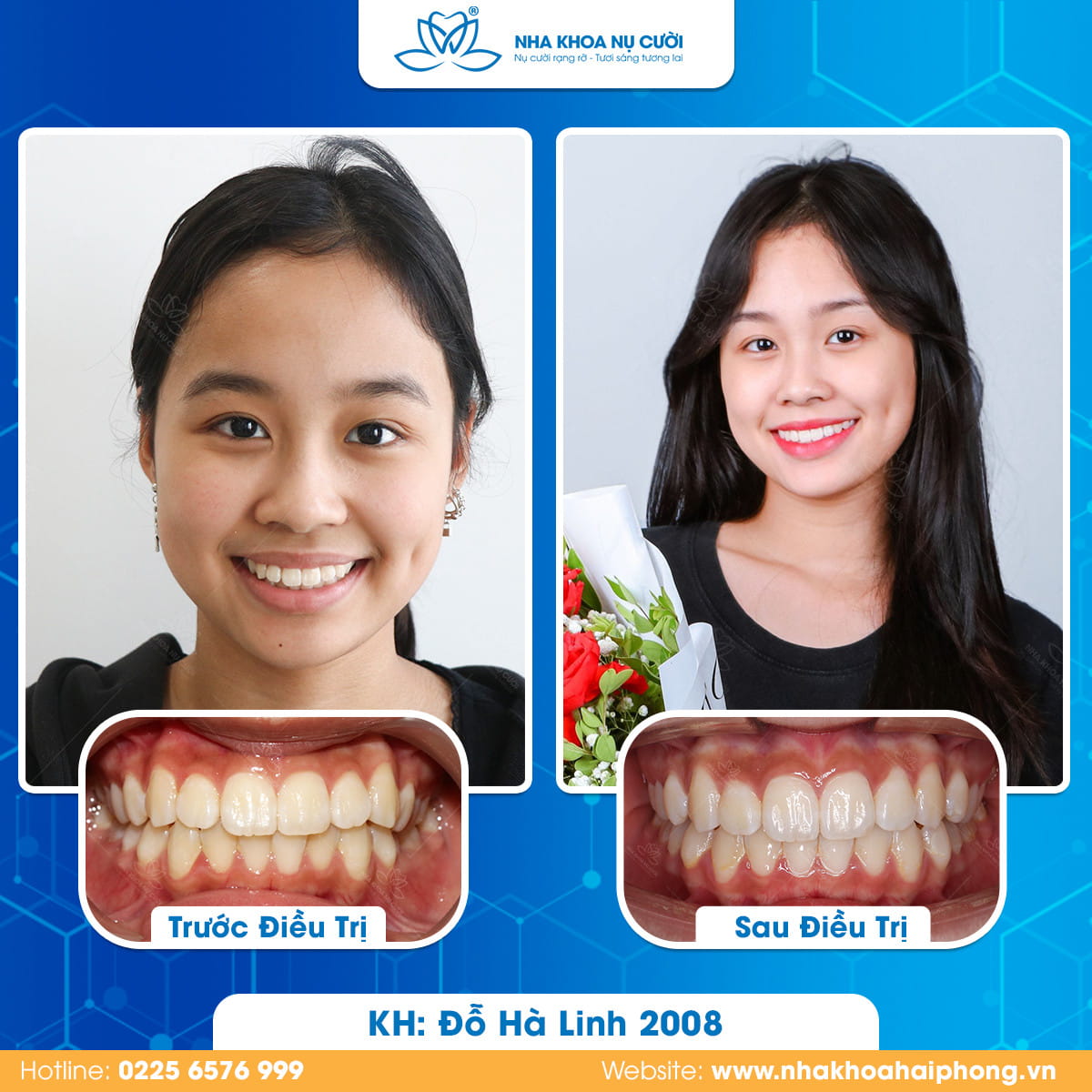 Niềng Răng Có Thay Đổi Khuôn Mặt Không? Sự Thật Bạn Nên Biết